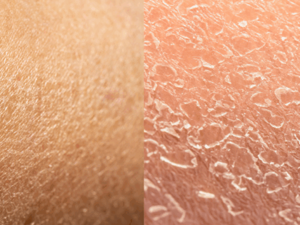 What’s the Difference Between Dry and Dehydrated Skin?