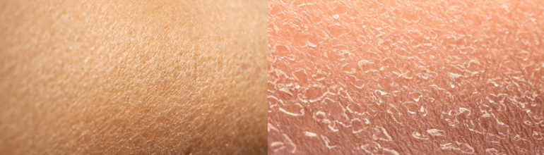 What’s the Difference Between Dry and Dehydrated Skin?
